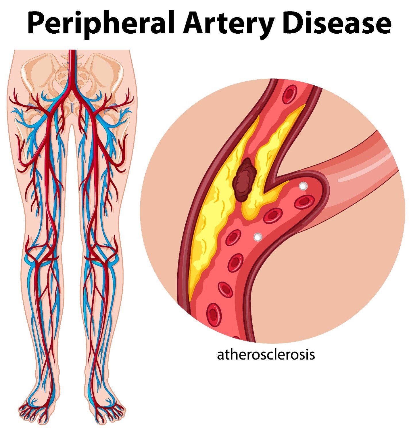 Peripheral Artery Disease PAD   Symptoms & Treatments